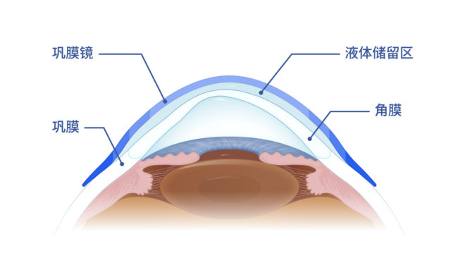 浙东首批！宁波鄞州眼科引入巩膜镜，三例难治角膜病患者“尝鲜”效果