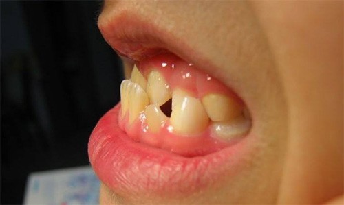 孩子牙不齐，什么情况下才矫正，防止过度医疗！